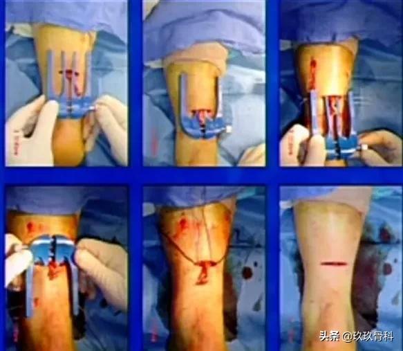 跟腱断裂的确诊方法,超详细跟腱断裂的诊断与治疗