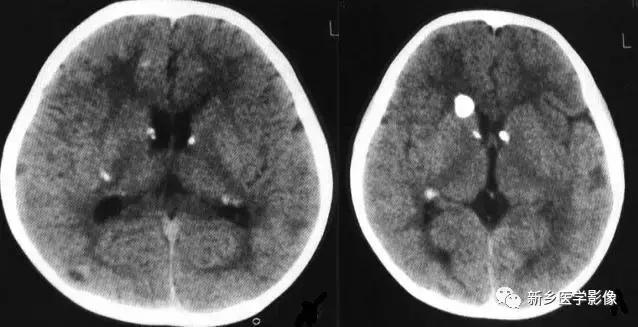 颅内有钙化怎么治疗,34岁脑部有钙化正常吗