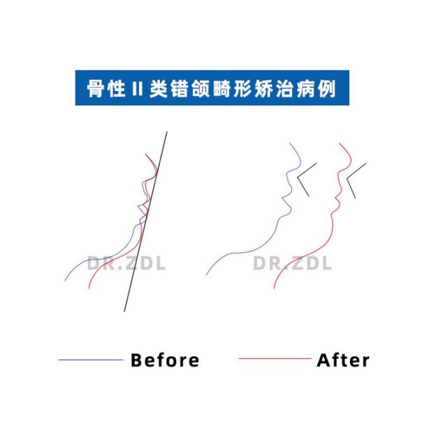 骨性龅牙和牙性龅牙的区别,牙性龅牙和骨性龅牙怎么矫正