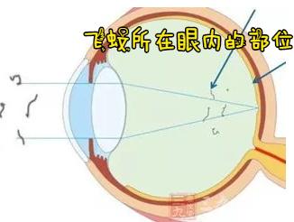 飞蚊症眼前有黑影原因,眼睛看到飞蚊症是怎么回事