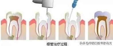 门牙龋坏了建议补牙还是做牙冠,龋坏补牙了还会坏吗