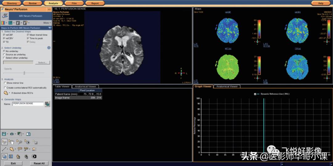 飞利浦磁共振脑灌注怎么测量,飞利浦核磁诊断教学