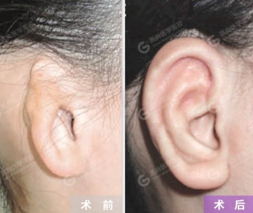 小耳再造手术,小耳畸形再造术案例集锦
