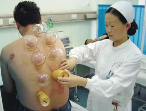 拔罐的黑印真的是体内毒素吗？拔罐师傅给出解释，看完长见识了！