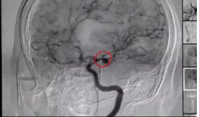 高龄老人脑出血微创手术成功,73岁老人脑动脉瘤破裂开颅手术