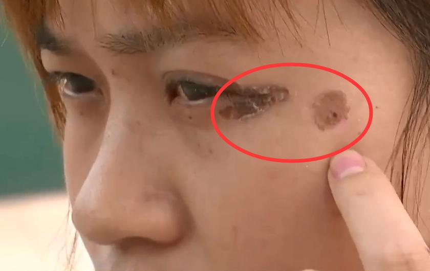 服装导购隔壁点痣，付完150直接注射液体！女子怒：不闭眼就被搞瞎