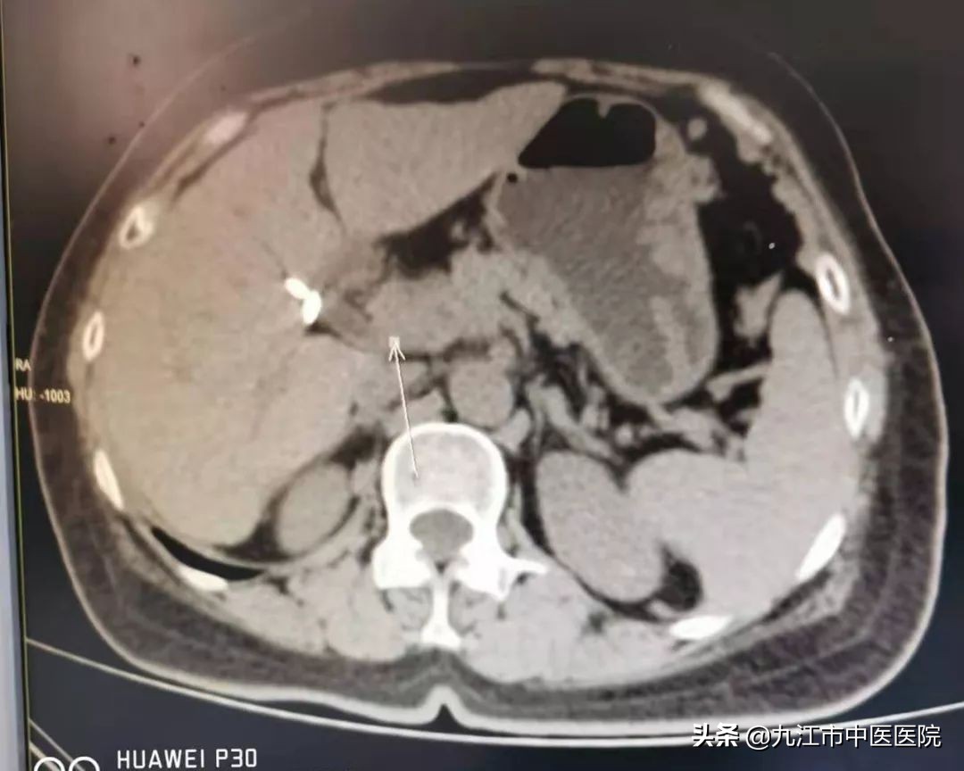 胰腺癌晚期中药治疗带瘤生存奇迹,胰腺癌中医治疗生存期