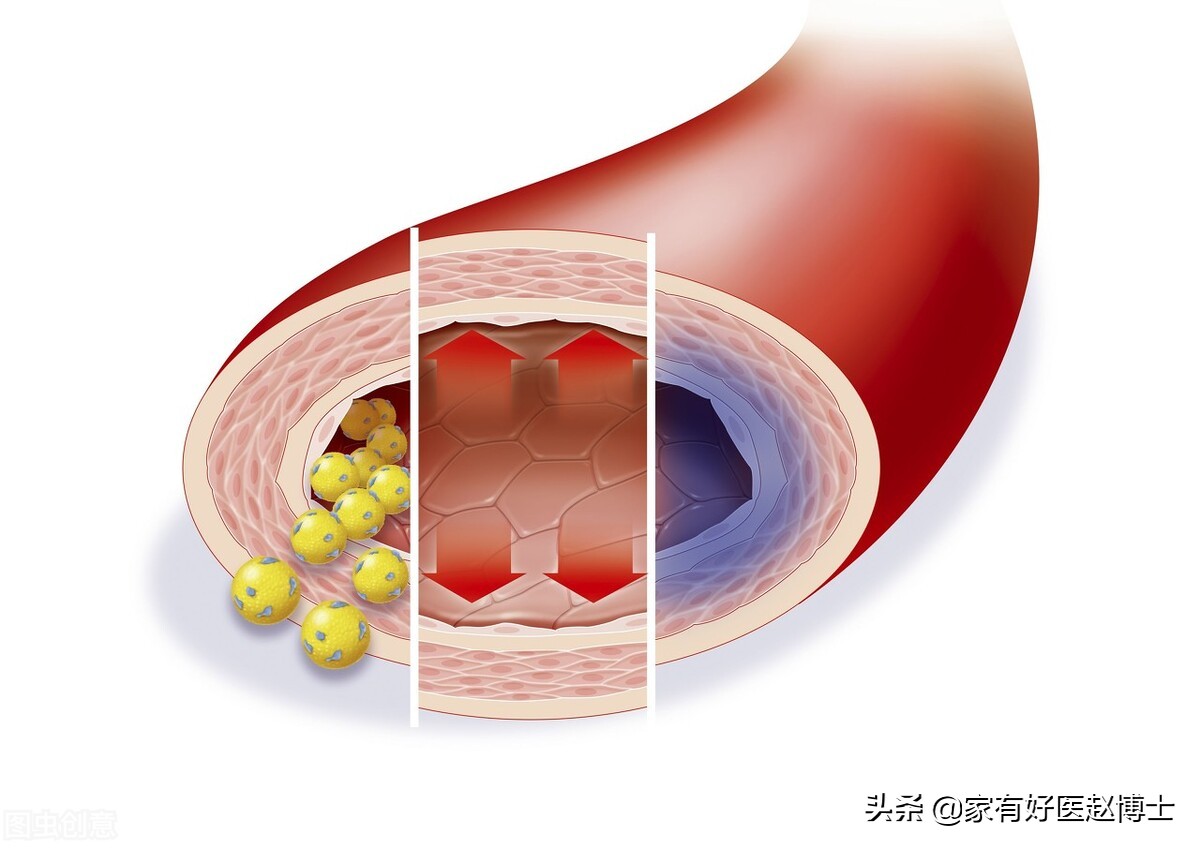 减缓血管老化做好以下几点,老人血管老化可以吃安宫牛黄丸吗
