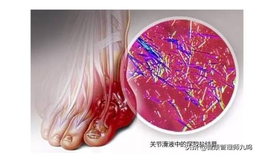 没想到!痛风要吃乌鸡白凤丸