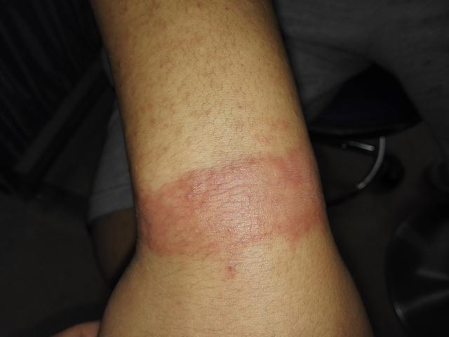 后背贴完膏药特别痒怎么回事,戴完手表手上起红印