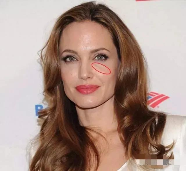 皮肤衰老了，长了印第安纹怎么办？