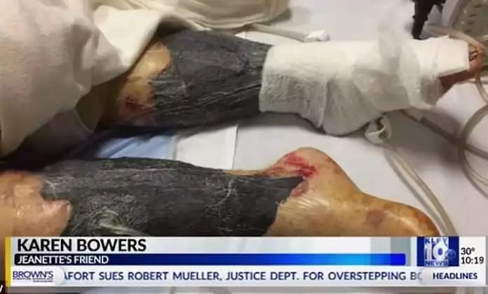 紧急！全澳多地出现“吃人菌”，感染后如同丧尸！24小时可吃一人