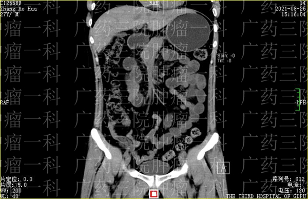 广药三院肿瘤一科如何治疗结肠癌导致的癌痛