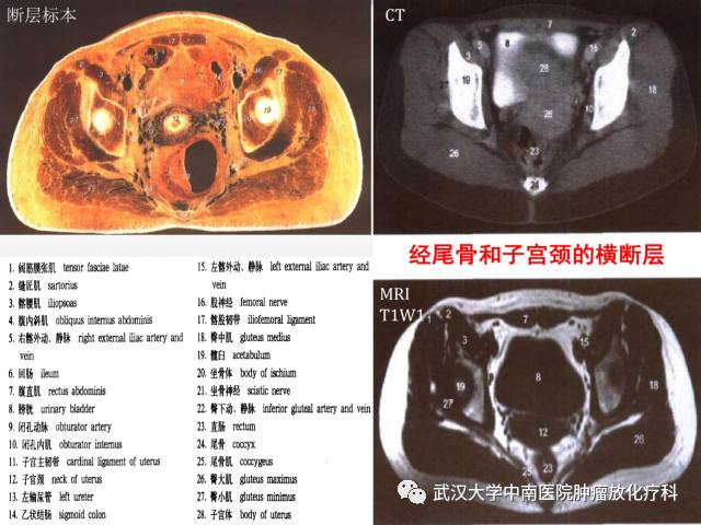 女性盆腔解剖与断层影像