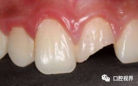 门牙折断牙根完好怎么办,门牙意外脱落怎么修复