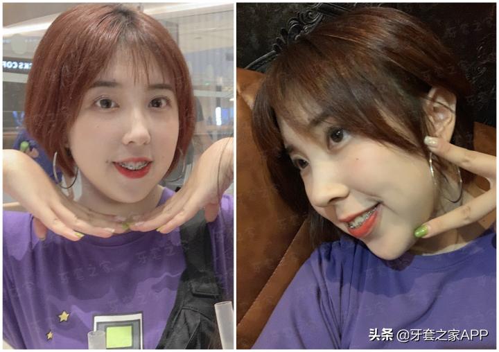 不靠整容怎么改变下巴后缩？看这里