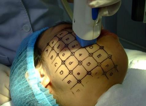 揭秘医美行业内幕：热玛吉、超声刀的“低价”3大陷阱