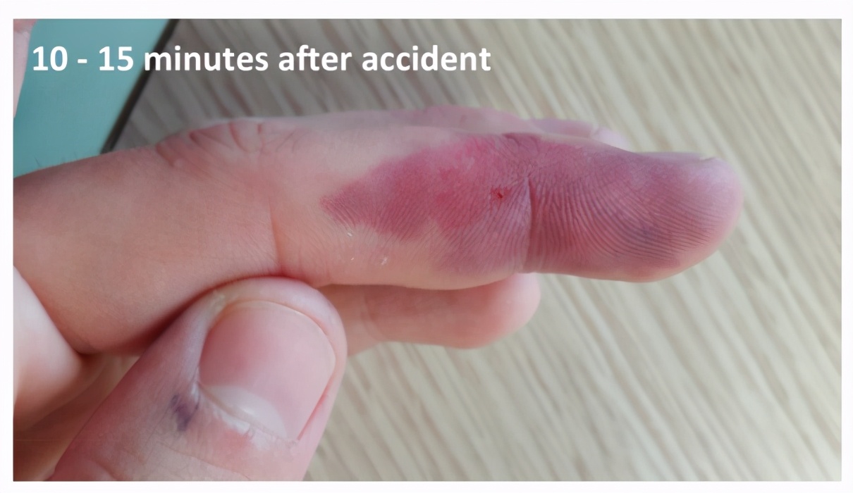 被实验室注射器针头扎到手,被实验室针头扎了一下怎么办