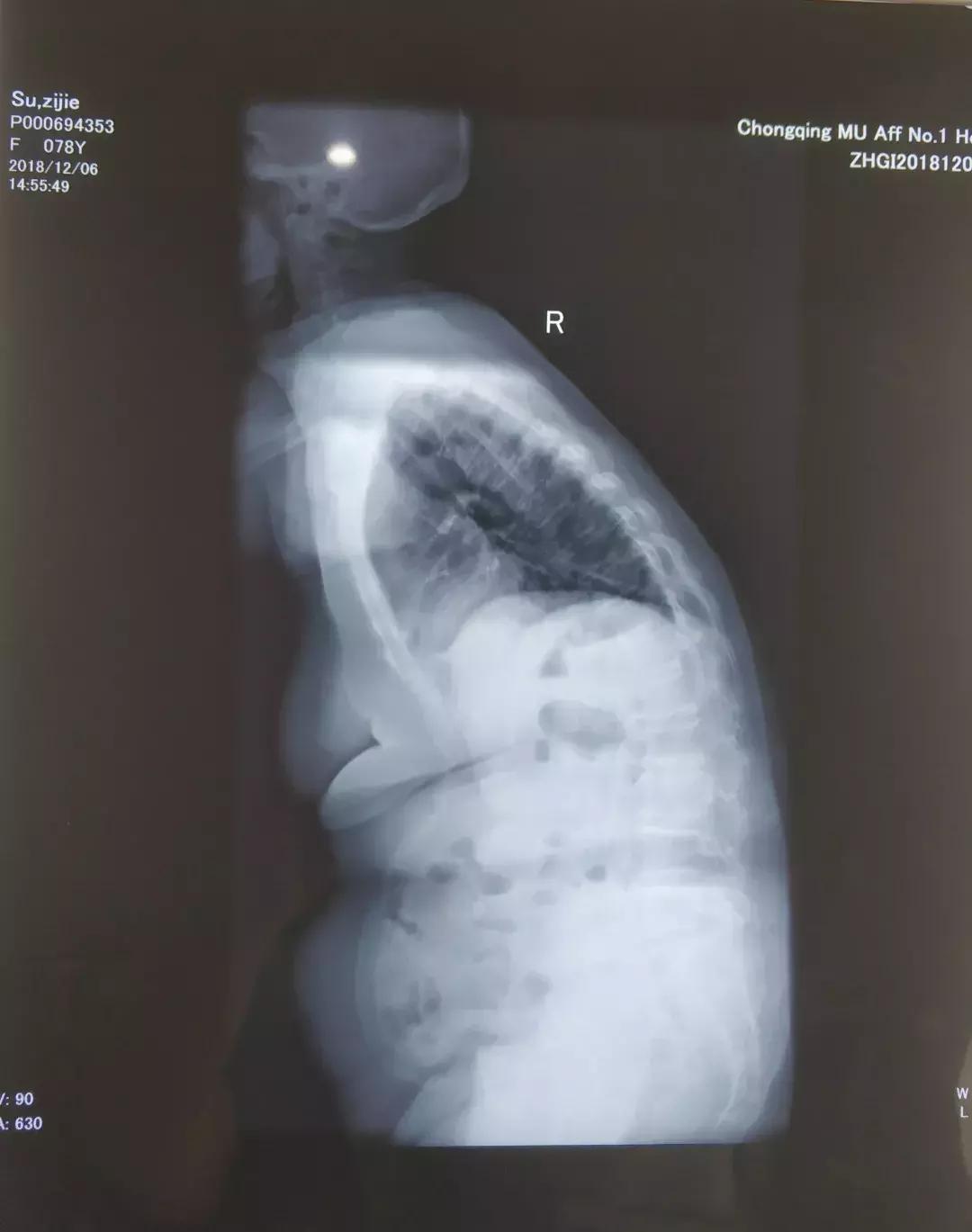 80岁老太太驼背90度能手术吗,老年人驼背有什么好的治疗方法