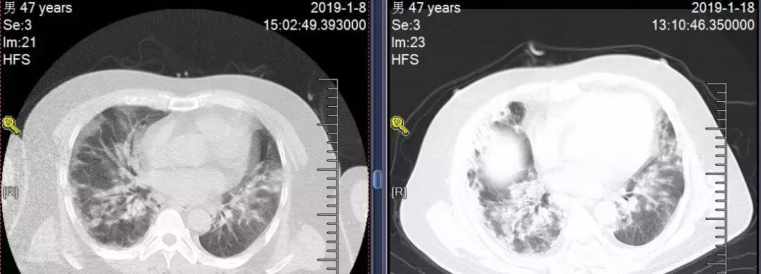 流感重症肺炎患者好转后皮疹、口腔白膜，流感病毒感染如何用激素