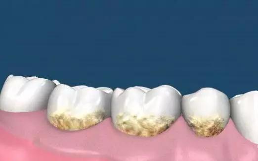 自己抠下来一块牙结石,自己动手抠牙结石