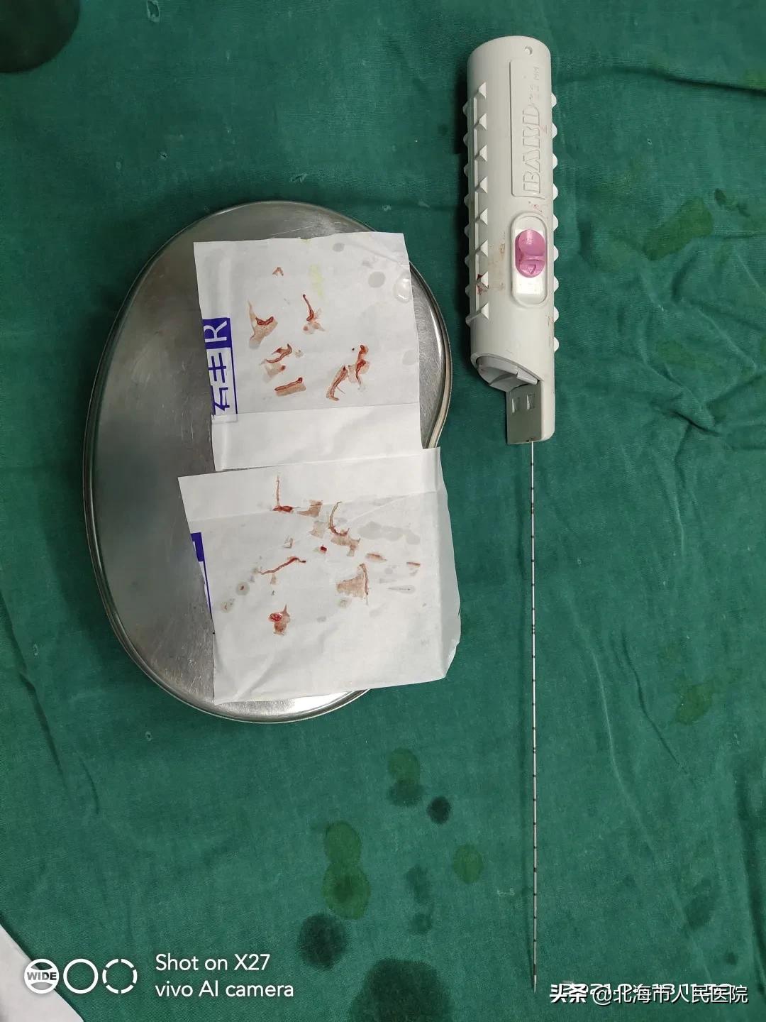 提高手术难度,降低感染风险——我院泌尿外科开展局麻下经会阴部超声引导下前列腺穿刺活检术