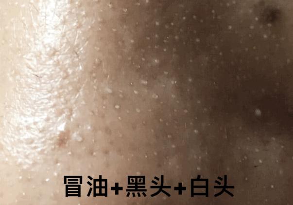 长黑头VS不长黑头差距这么大?精致女孩如何绕过黑头这道坎?