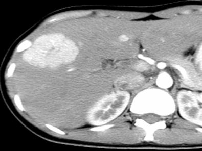 发现肝脏实性占位后做什么检查,肝脏阴影或占位有可能是哪些病