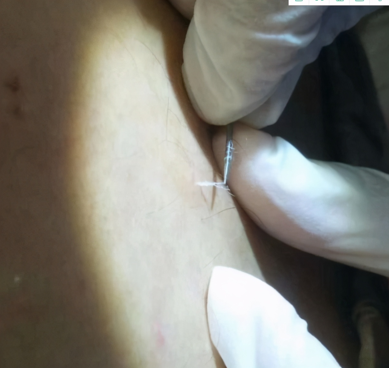 有痔疮的人后背有一道印,有痔疮突然出现小肉球