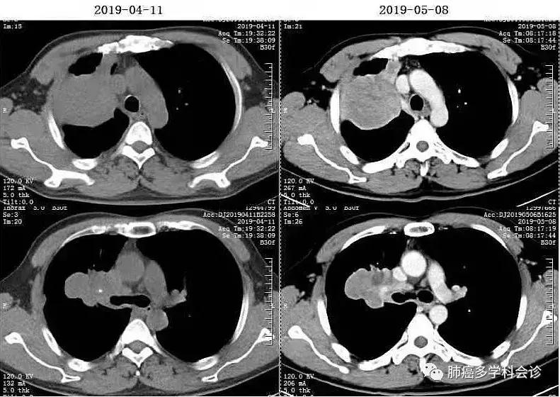 上海专家肿瘤治疗新探索,肿瘤诊疗一体化治疗方案