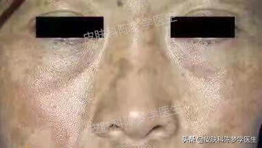 如何治疗脸上褐青色痣样斑,什么是褐青痣斑