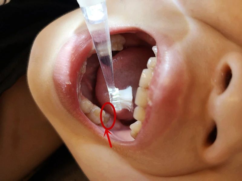 小孩口腔最里面有双排牙,孩子嘴里出了好多牙