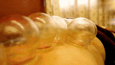 拔罐减肥瘦了30斤食谱,拔罐减肥一周能瘦多少