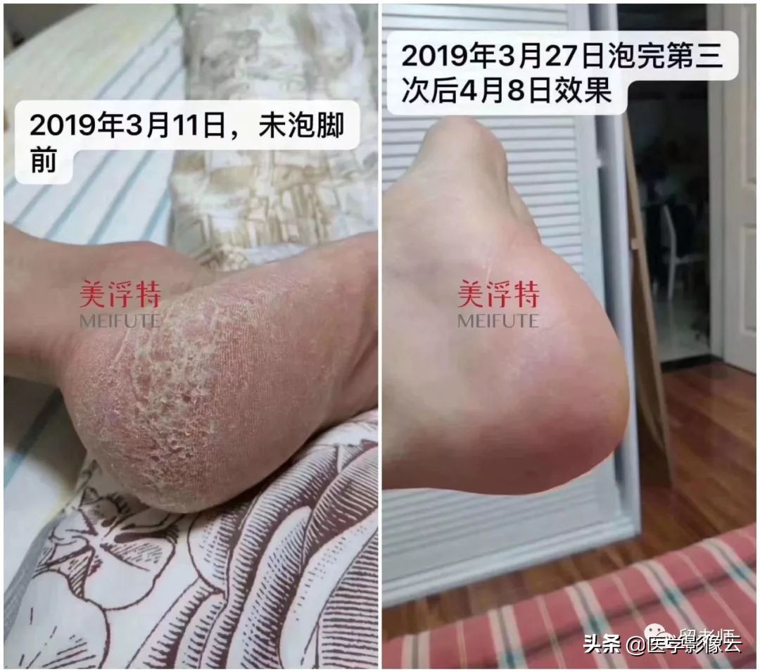 这是一条有味道的推送—jio气复发肿么办?