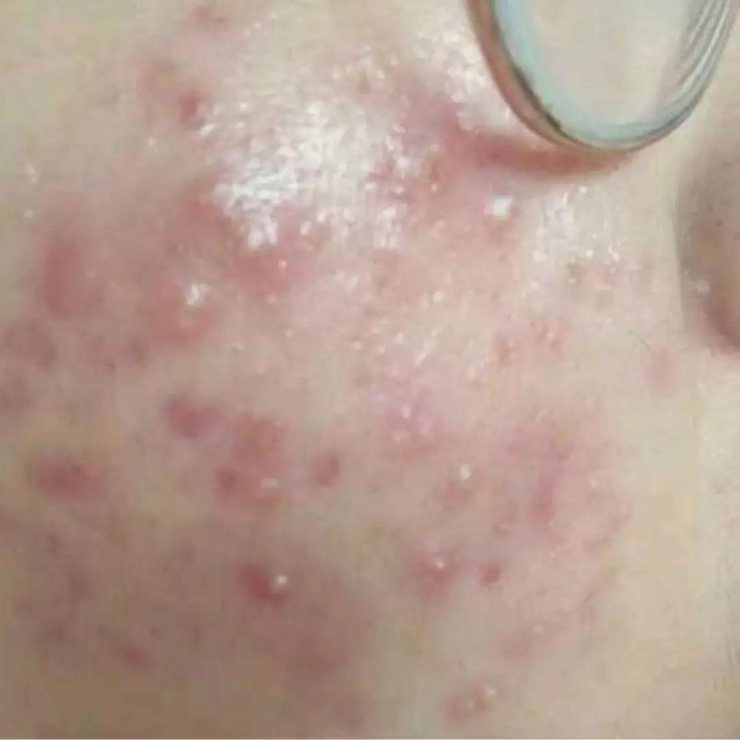 祛痘印的方法怎么可以快速祛痘印,怎样有效快速祛痘祛痘印