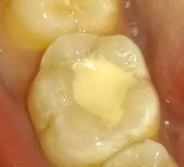 怎么样看牙最省钱,看牙嫌贵这个省钱机会千万别错过