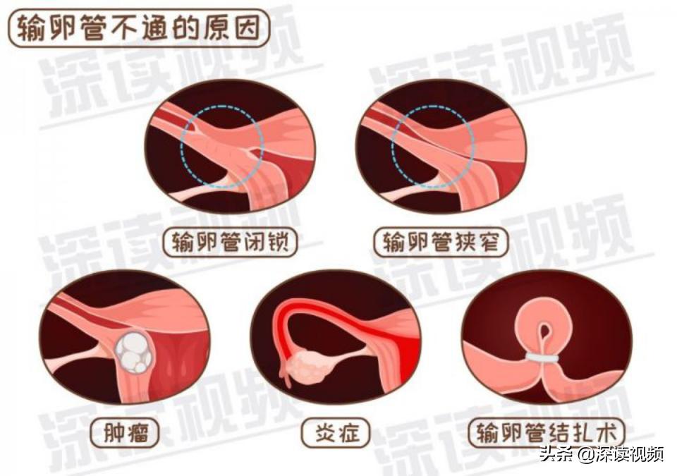 宫外孕还来大姨妈怎么回事,陈旧性宫外孕是怎么回事