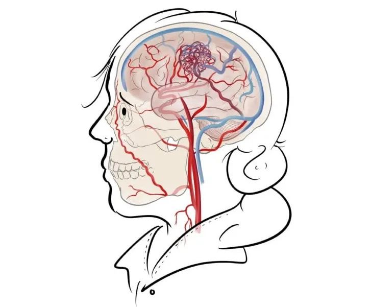 小脑血管畸形可以保守治疗吗,脑血管畸形出血保守治疗方法