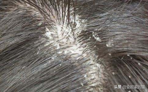 去油去头屑用什么洗发水最好,头屑多头痒用什么洗发水比较好