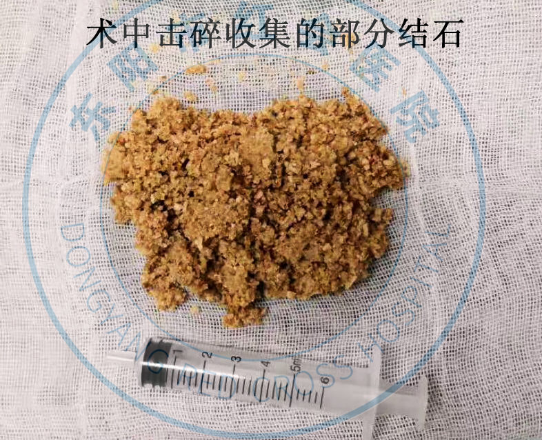 左肾长满鹿角结石,大妈肾内结石