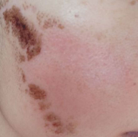 点阵激光能把伤疤完全修复吗,激光点阵可以修复到多少程度