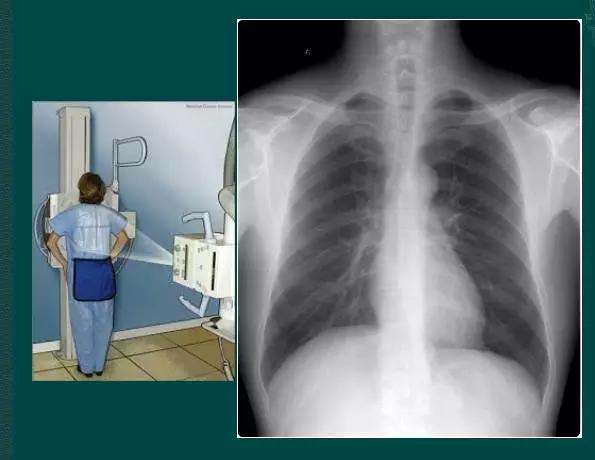 拿到胸部ct我们该怎么看,怎样看懂胸片报告单