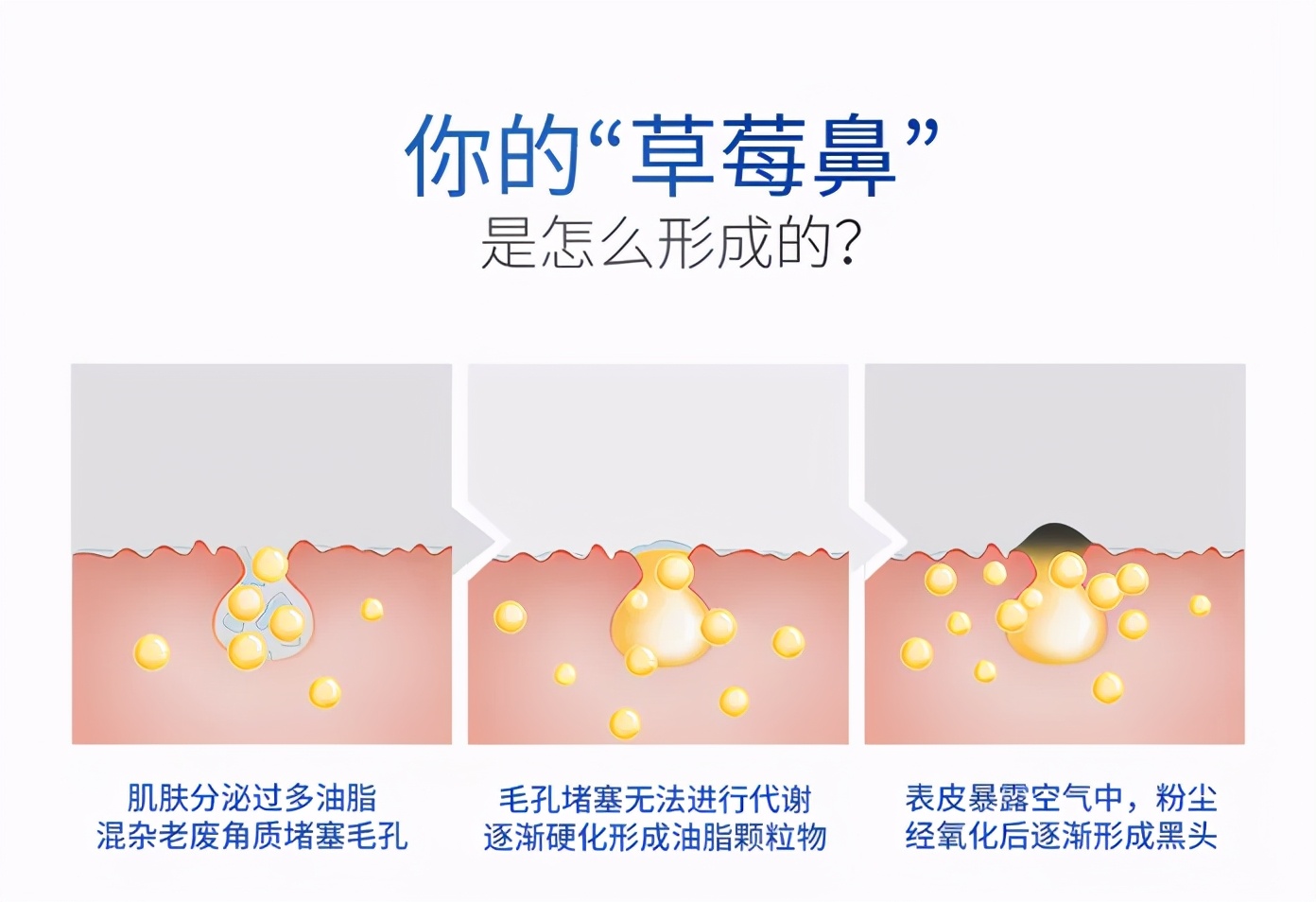 黑头毛孔大怎么去除最有效医学,祛除鼻子黑头的有效方法是什么