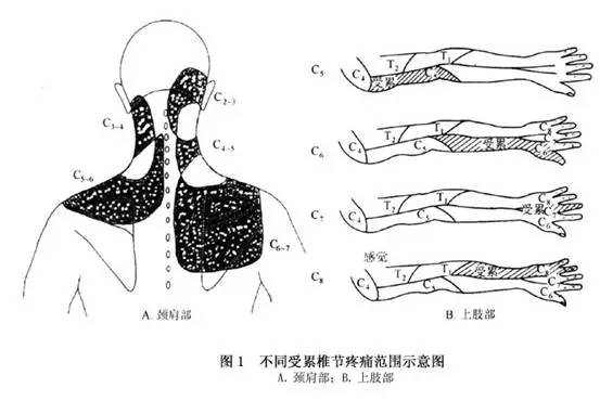 我的颈椎病是神经根型颈椎病如何保守治疗不希望手术