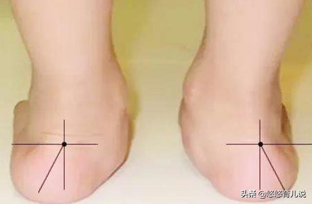 四岁宝宝脚趾变形是什么原因,孩子脚中指变形