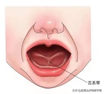 孩子说话不清晰,咬音不准。是“舌系带”过短导致的么?