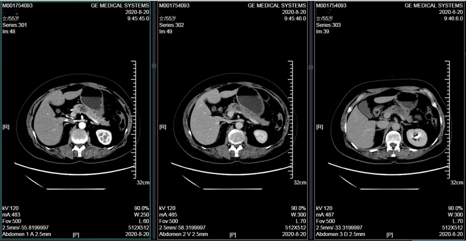 胰腺囊肿3.2x4.2必须手术吗,三厘米的胰腺头良性囊肿如何手术