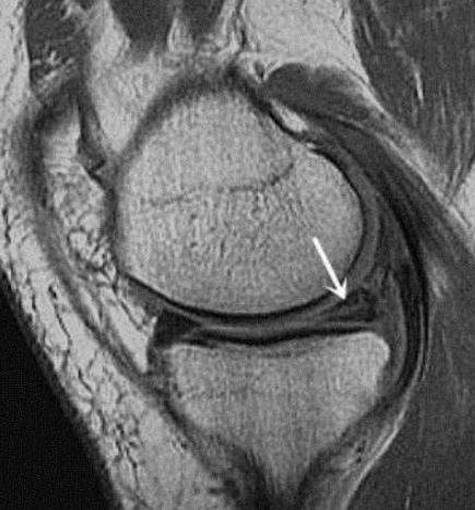 关节镜半月板撕裂手术几天能出院,关节镜半月板修复术后弯曲难