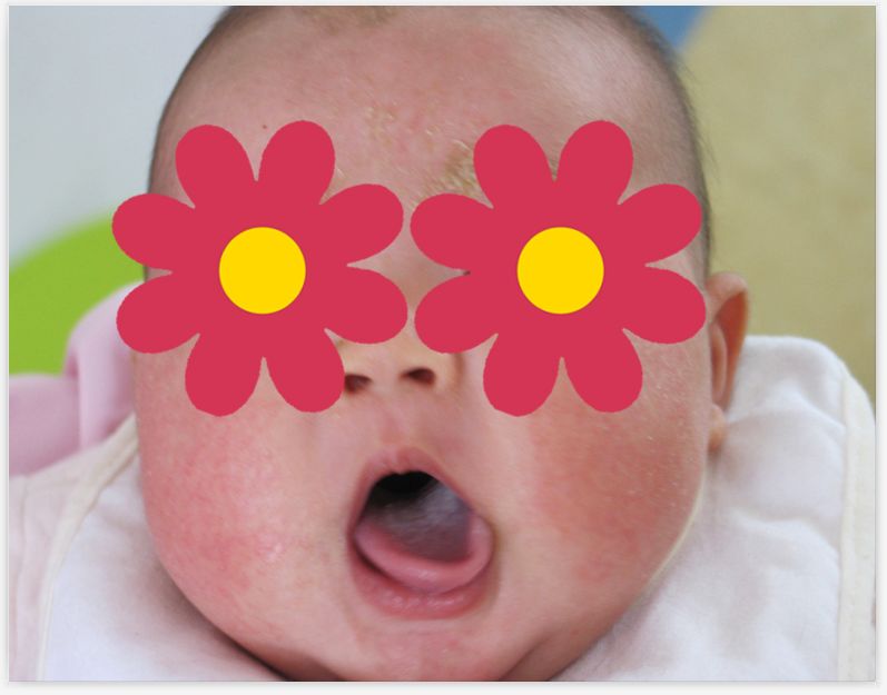 吃着祛湿疹的药为什么湿疹加重,宝宝湿疹吃韭菜喂奶会加重湿疹吗