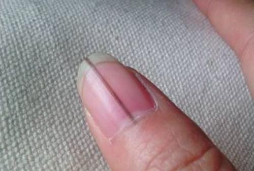 指甲有竖条纹是大病的前兆吗,指甲出现褐色竖纹代表什么病